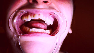 Preparing for Invisible Aligners